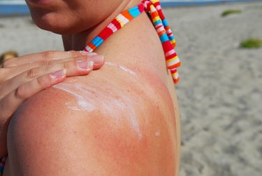 close view of a person's shoulder with sunburn